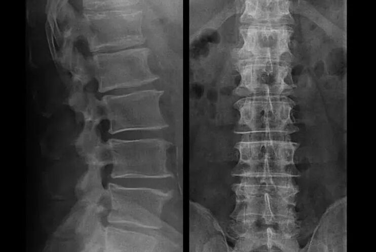 Osteochondrosis on x-ray