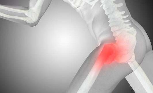 Arthrosis of the hip joint