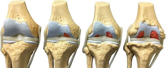 Deformation of the knee osteoarthritis