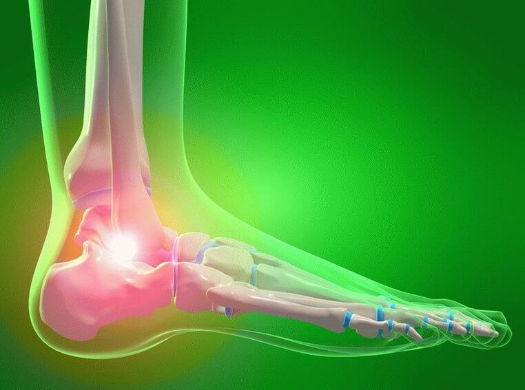 Foot arthrosis