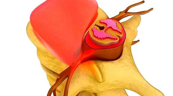 Osteochondrosis of the thoracic spine The essence of the disease