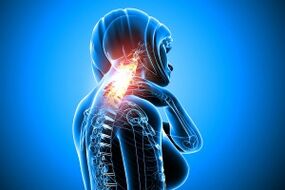 Osteochondrosis in the cervical spine